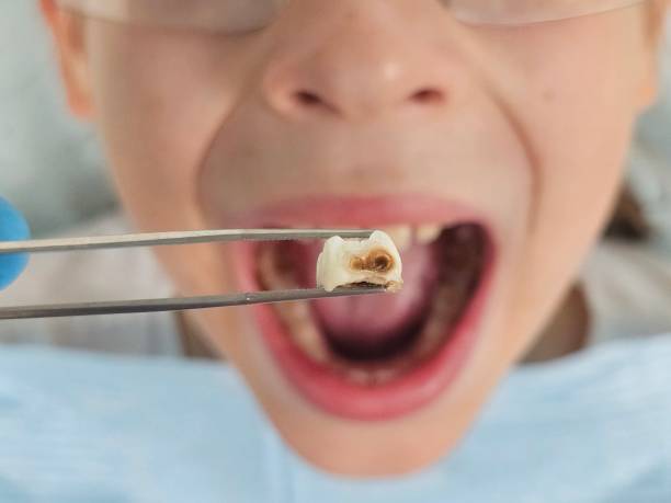 Best Emergency Tooth Extraction in Harahan, LA